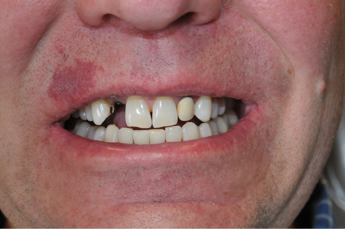 Before and after smiles at Alleman Family Dental Boulder, CO